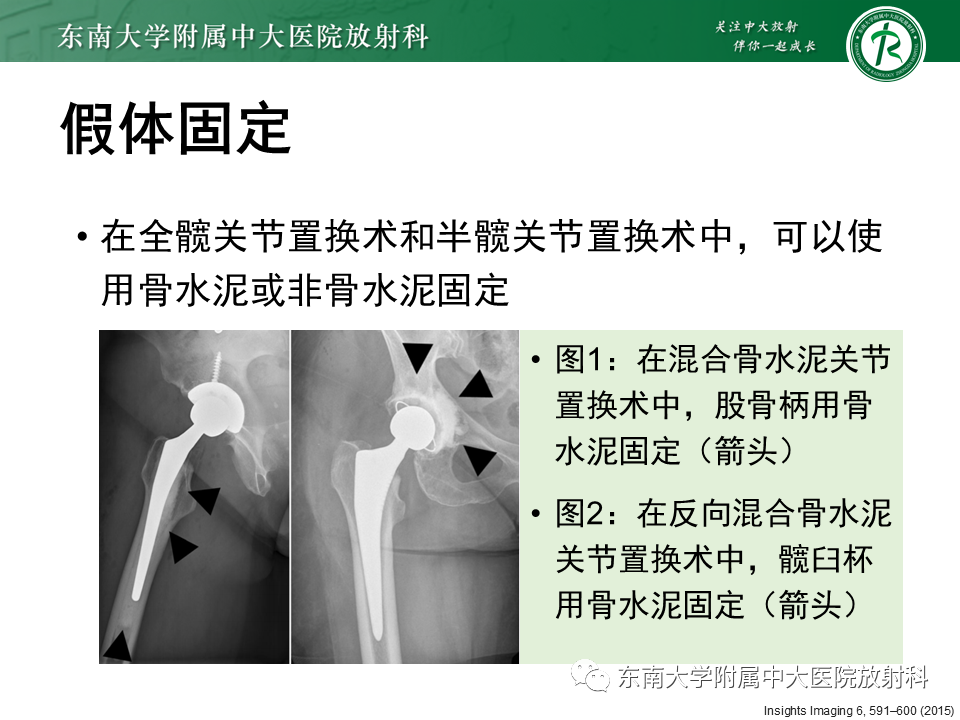 影像PPT - 【PPT】髋关节置换术后影像学评估-10 影像PPT - 【PPT】髋关节置换术后影像学评估-10