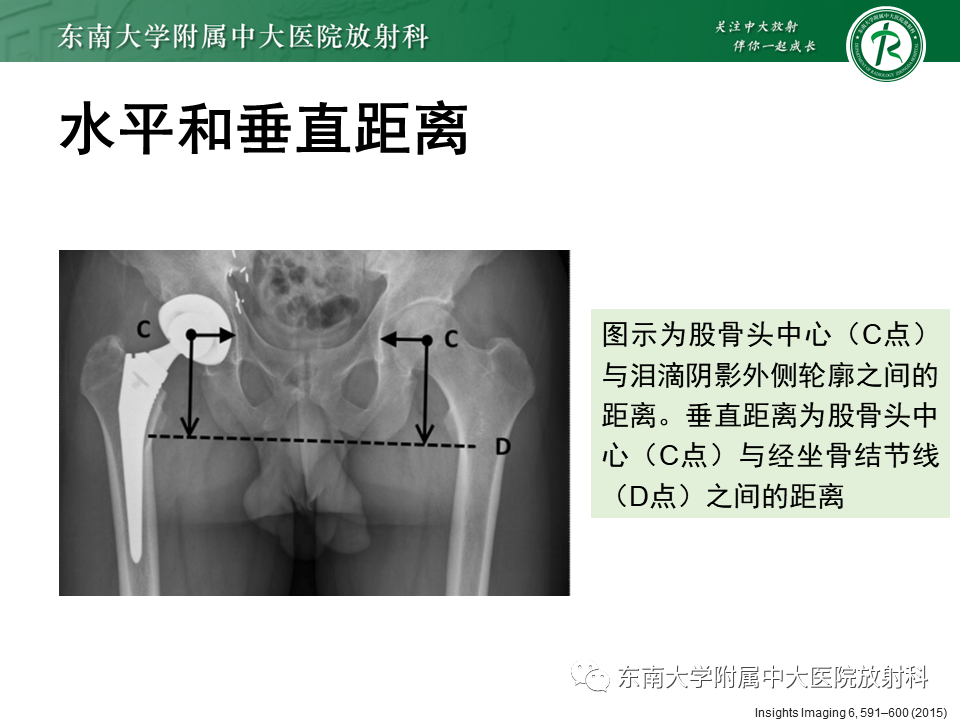 影像PPT - 【PPT】髋关节置换术后影像学评估-14 影像PPT - 【PPT】髋关节置换术后影像学评估-14