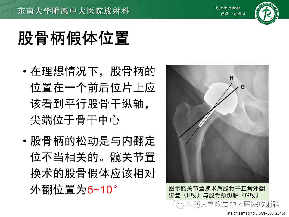 影像PPT - 【PPT】髋关节置换术后影像学评估-16 影像PPT - 【PPT】髋关节置换术后影像学评估-16