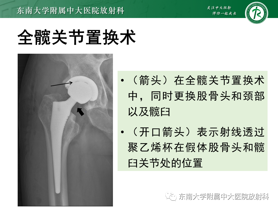 影像PPT - 【PPT】髋关节置换术后影像学评估-8 影像PPT - 【PPT】髋关节置换术后影像学评估-8