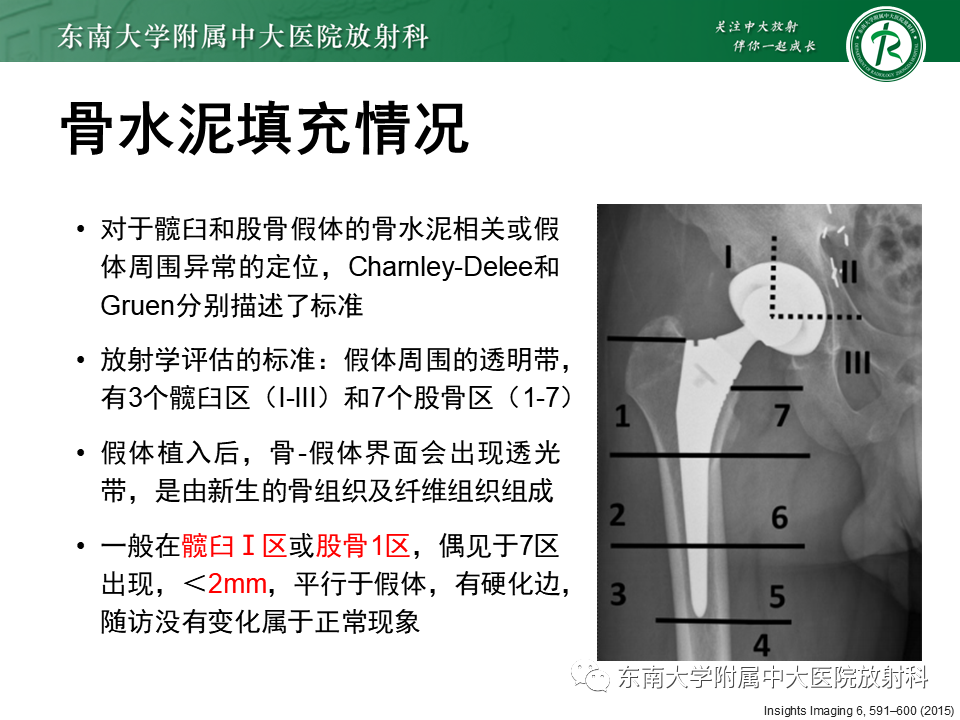影像PPT - 【PPT】髋关节置换术后影像学评估-20 影像PPT - 【PPT】髋关节置换术后影像学评估-20