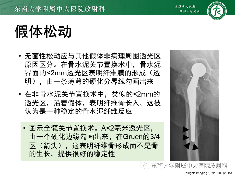 影像PPT - 【PPT】髋关节置换术后影像学评估-25 影像PPT - 【PPT】髋关节置换术后影像学评估-25