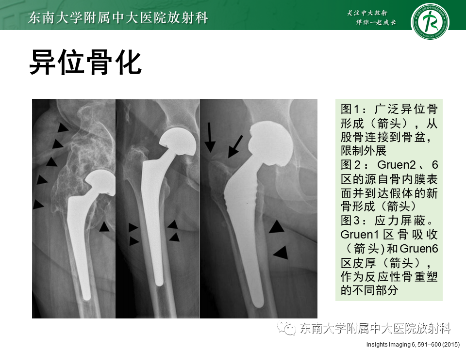 影像PPT - 【PPT】髋关节置换术后影像学评估-31 影像PPT - 【PPT】髋关节置换术后影像学评估-31