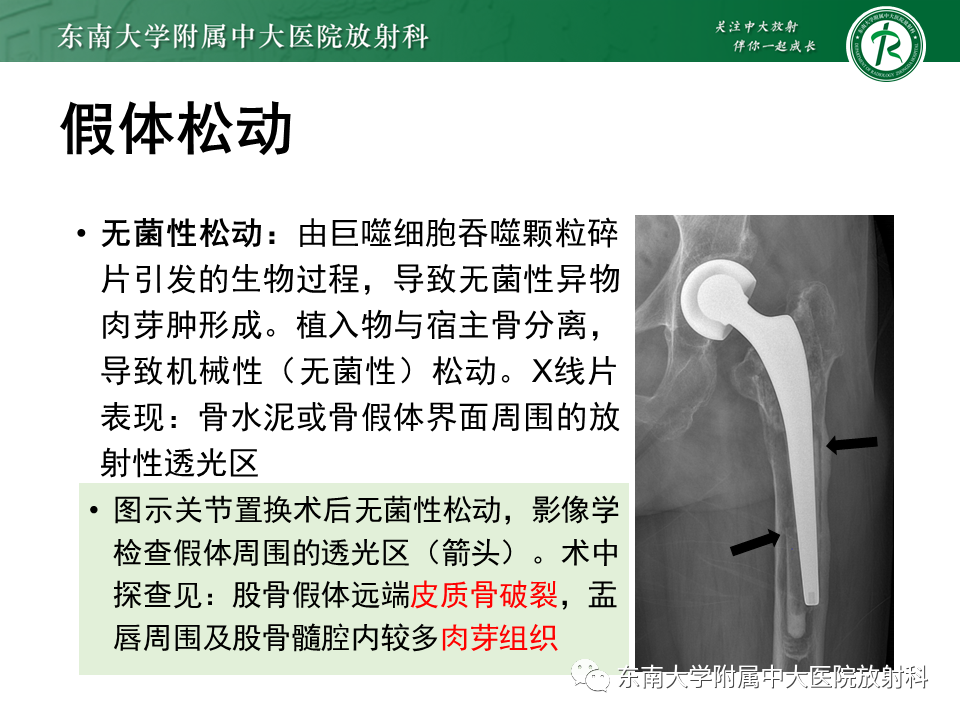 影像PPT - 【PPT】髋关节置换术后影像学评估-24 影像PPT - 【PPT】髋关节置换术后影像学评估-24