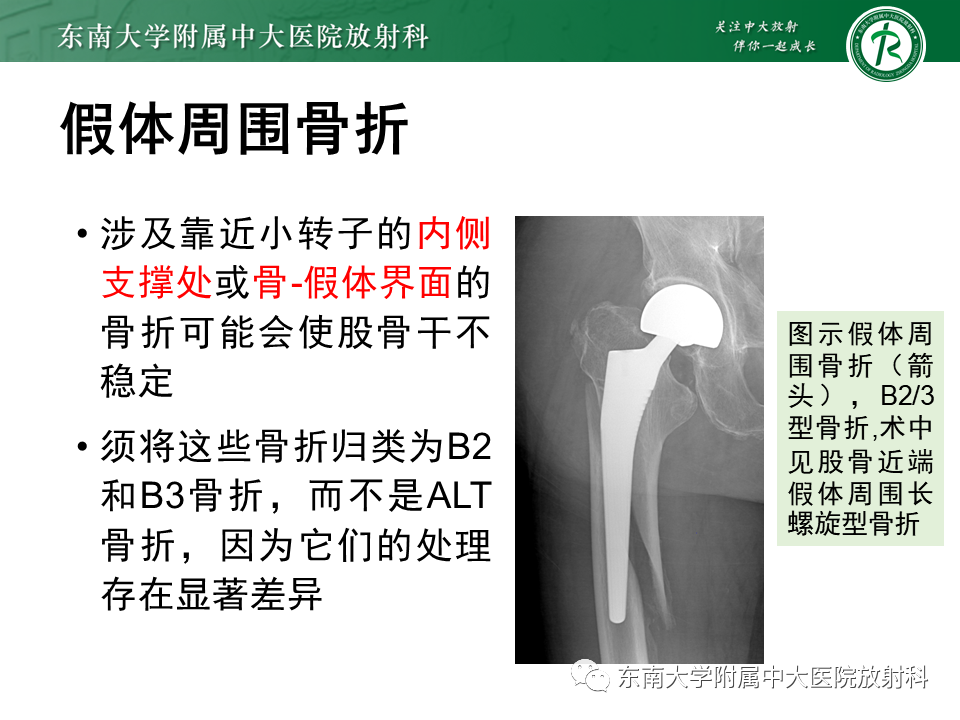 影像PPT - 【PPT】髋关节置换术后影像学评估-38 影像PPT - 【PPT】髋关节置换术后影像学评估-38