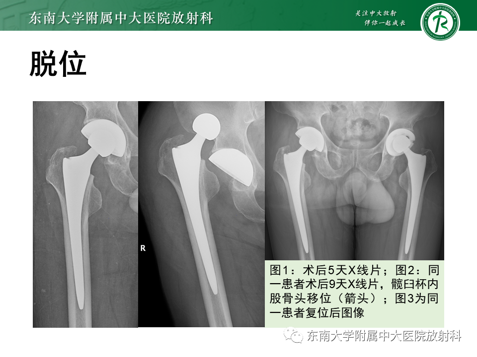 影像PPT - 【PPT】髋关节置换术后影像学评估-34 影像PPT - 【PPT】髋关节置换术后影像学评估-34
