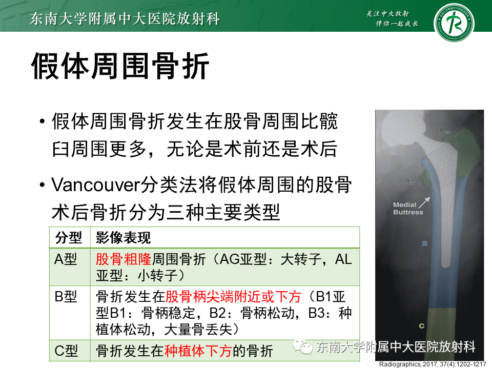 影像PPT - 【PPT】髋关节置换术后影像学评估-35 影像PPT - 【PPT】髋关节置换术后影像学评估-35