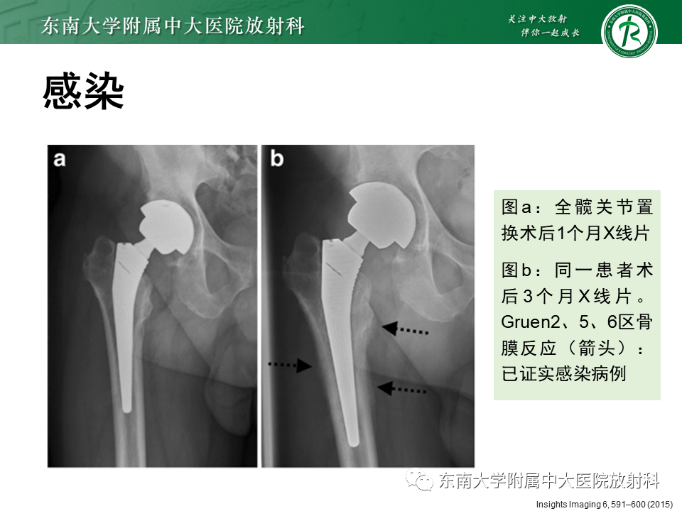 影像PPT - 【PPT】髋关节置换术后影像学评估-28 影像PPT - 【PPT】髋关节置换术后影像学评估-28