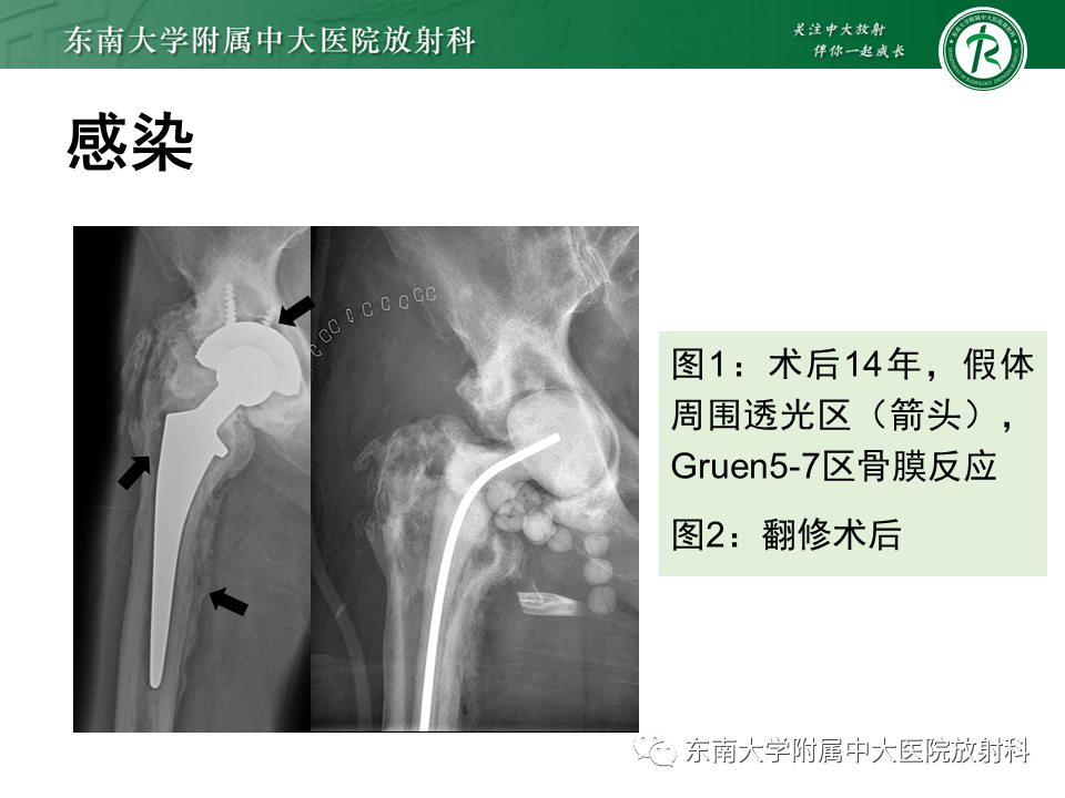 影像PPT - 【PPT】髋关节置换术后影像学评估-27 影像PPT - 【PPT】髋关节置换术后影像学评估-27