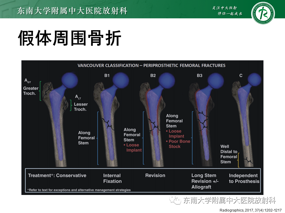 影像PPT - 【PPT】髋关节置换术后影像学评估-36 影像PPT - 【PPT】髋关节置换术后影像学评估-36