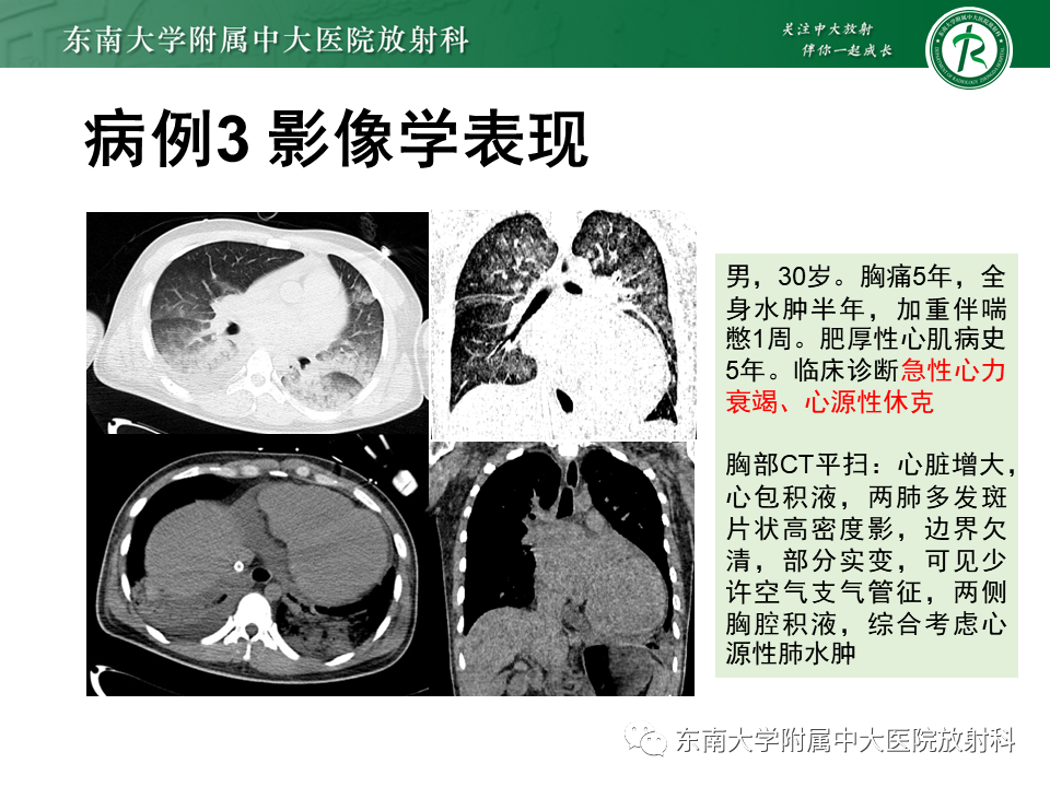 影像PPT - 【PPT】肺泡蛋白沉积症(PAP)-14