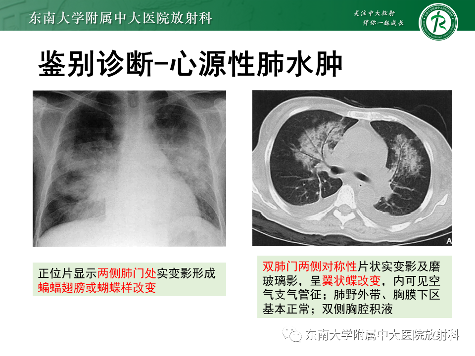 影像PPT - 【PPT】肺泡蛋白沉积症(PAP)-13