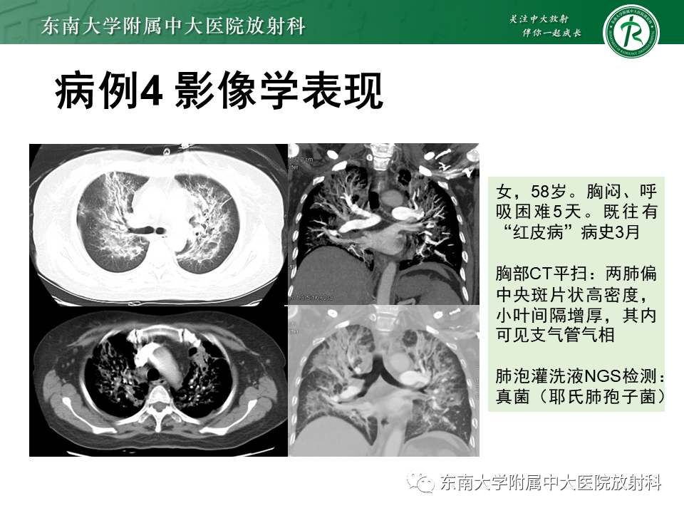 影像PPT - 【PPT】肺泡蛋白沉积症(PAP)-16