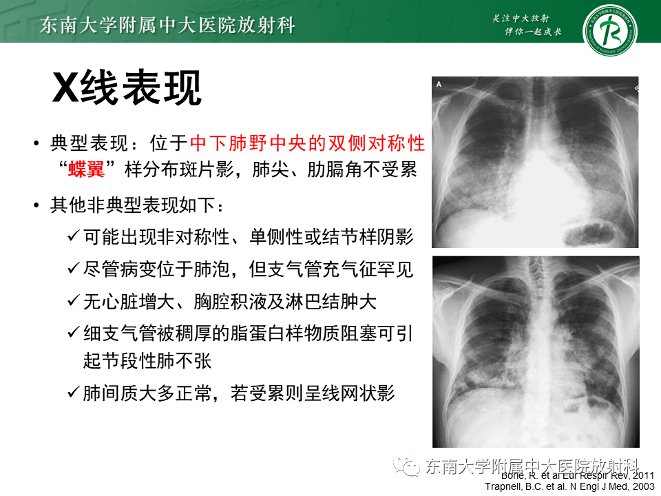 影像PPT - 【PPT】肺泡蛋白沉积症(PAP)-7