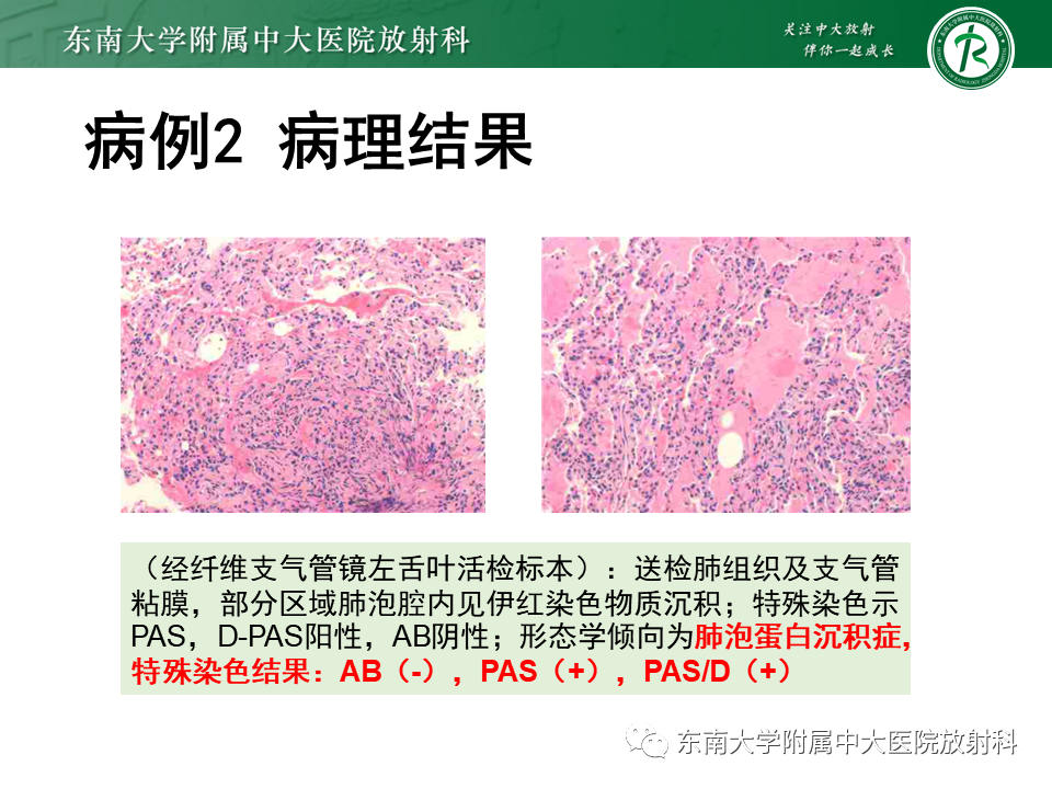 影像PPT - 【PPT】肺泡蛋白沉积症(PAP)-10