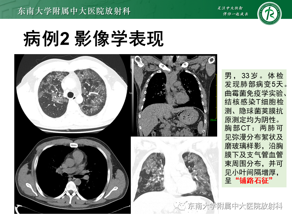 影像PPT - 【PPT】肺泡蛋白沉积症(PAP)-9