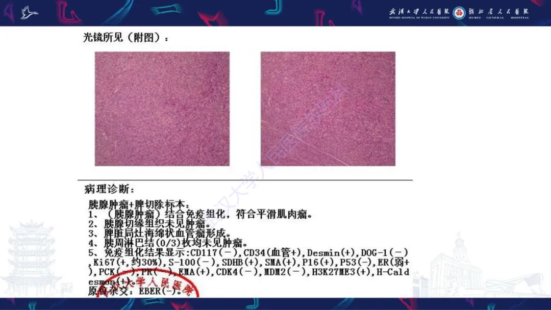 影像PPT - 【PPT】胰腺平滑肌肉瘤影像诊断-10