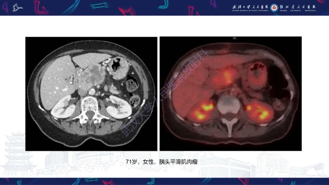 影像PPT - 【PPT】胰腺平滑肌肉瘤影像诊断-15