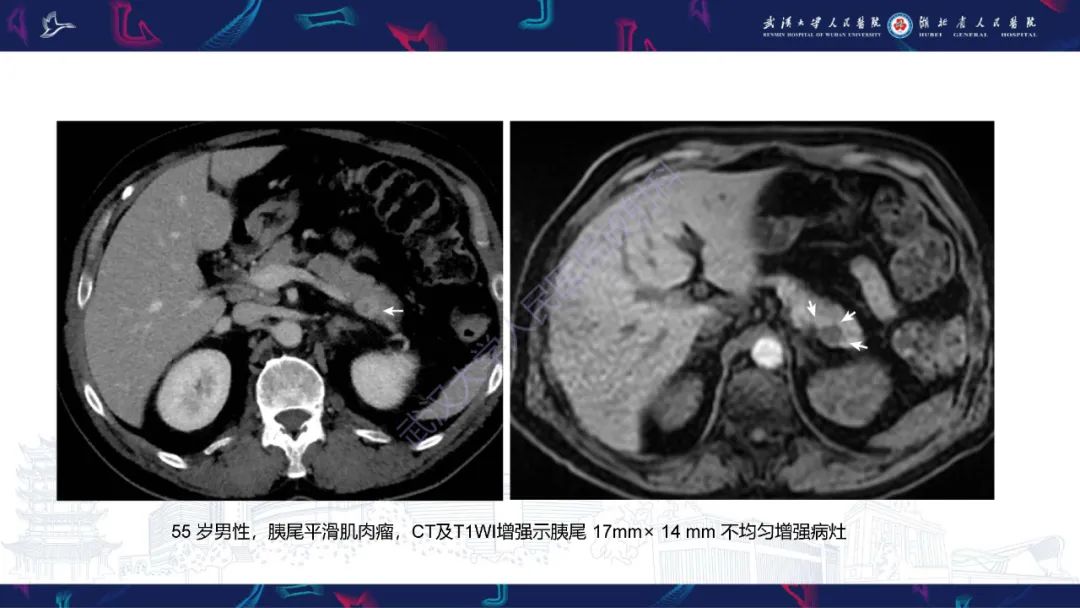影像PPT - 【PPT】胰腺平滑肌肉瘤影像诊断-16