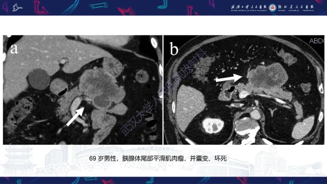 影像PPT - 【PPT】胰腺平滑肌肉瘤影像诊断-18
