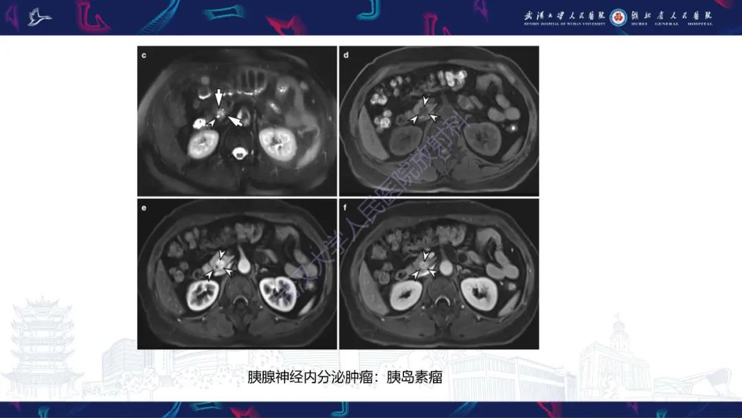 影像PPT - 【PPT】胰腺平滑肌肉瘤影像诊断-27