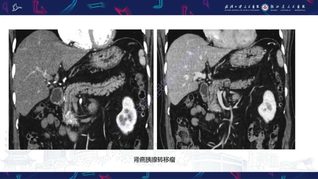 影像PPT - 【PPT】胰腺平滑肌肉瘤影像诊断-30