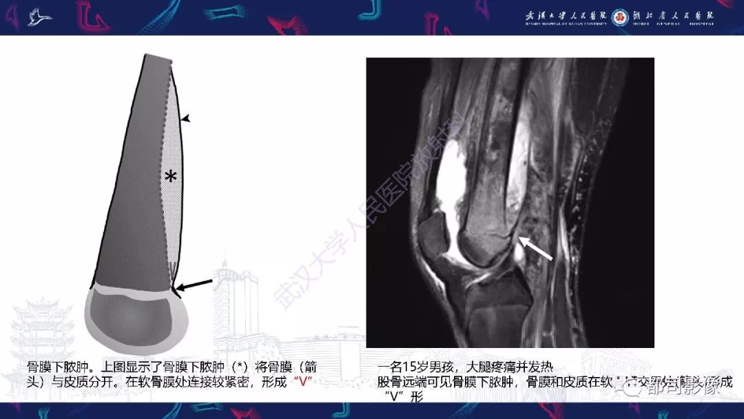 影像PPT - 【PPT】婴幼儿血源性骨髓炎-9