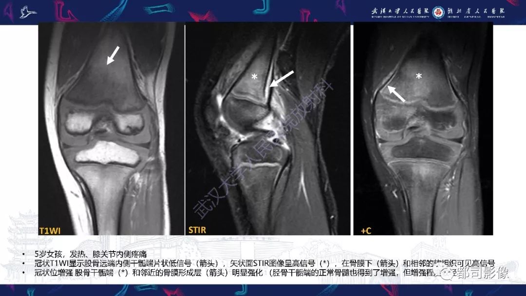 影像PPT - 【PPT】婴幼儿血源性骨髓炎-14