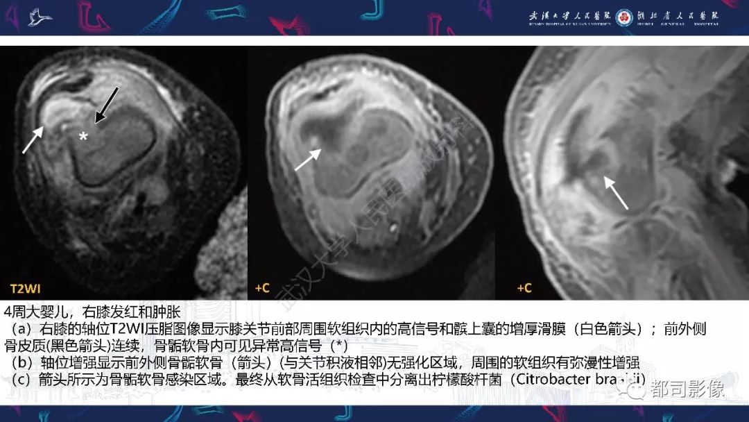 影像PPT - 【PPT】婴幼儿血源性骨髓炎-18