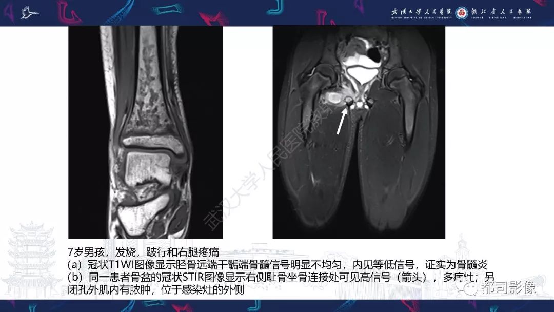 影像PPT - 【PPT】婴幼儿血源性骨髓炎-20