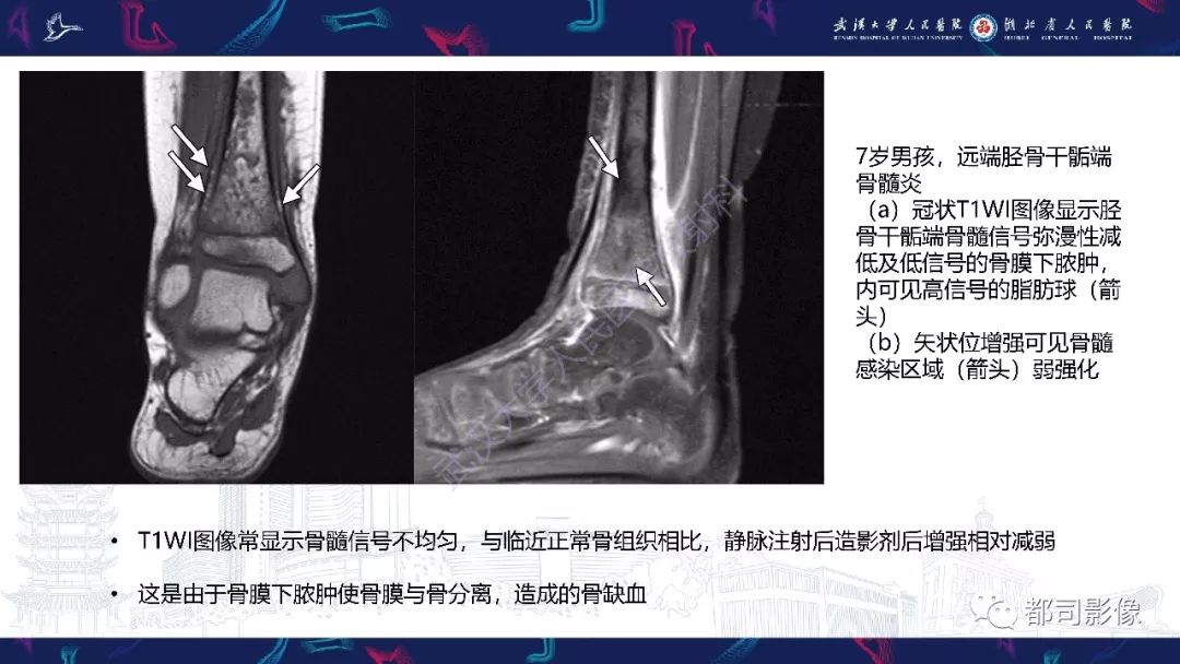 影像PPT - 【PPT】婴幼儿血源性骨髓炎-24