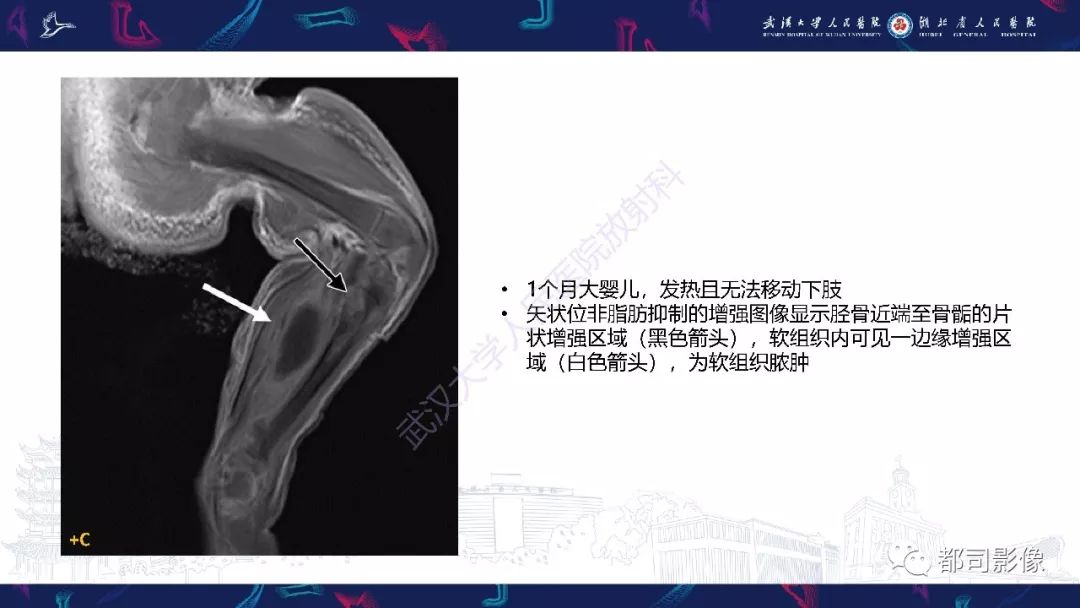 影像PPT - 【PPT】婴幼儿血源性骨髓炎-16