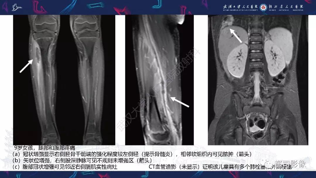 影像PPT - 【PPT】婴幼儿血源性骨髓炎-29