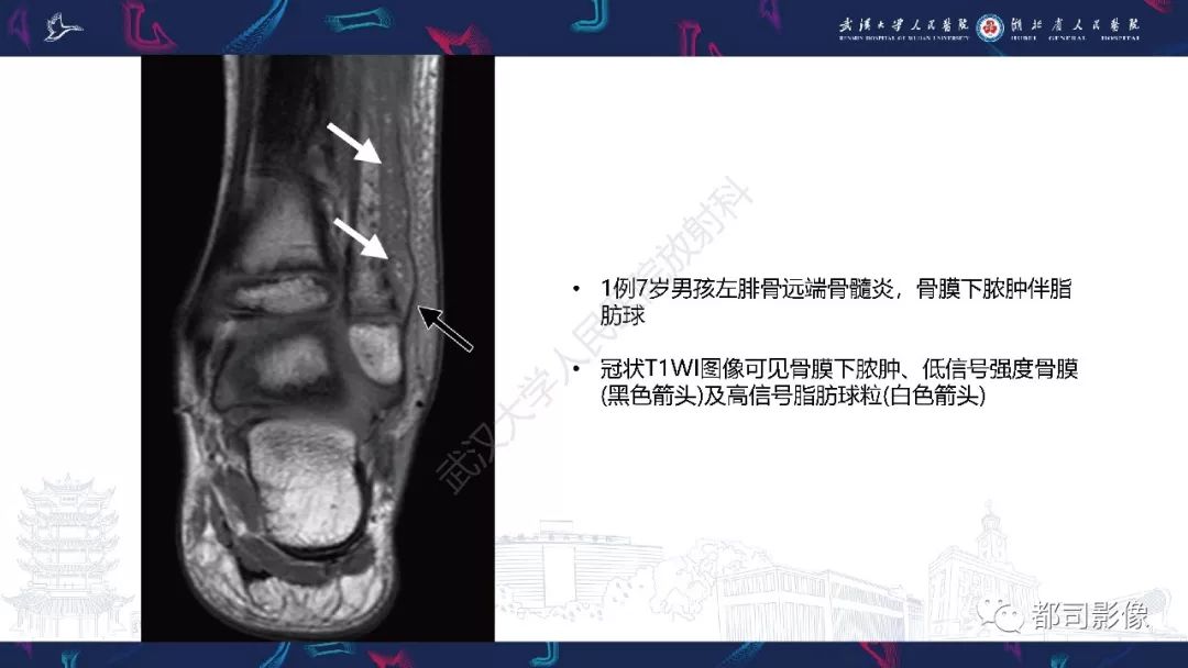 影像PPT - 【PPT】婴幼儿血源性骨髓炎-23
