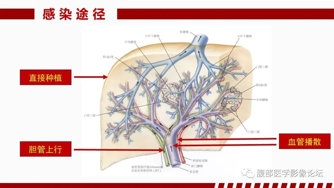 影像PPT - 【PPT】肝脏感染性疾病的多模态影像诊断及鉴别-11