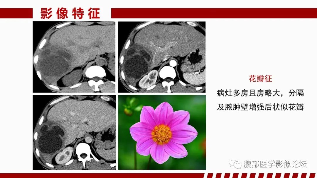 影像PPT - 【PPT】肝脏感染性疾病的多模态影像诊断及鉴别-15