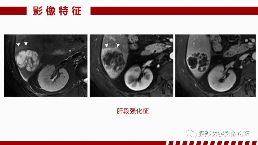 影像PPT - 【PPT】肝脏感染性疾病的多模态影像诊断及鉴别-17