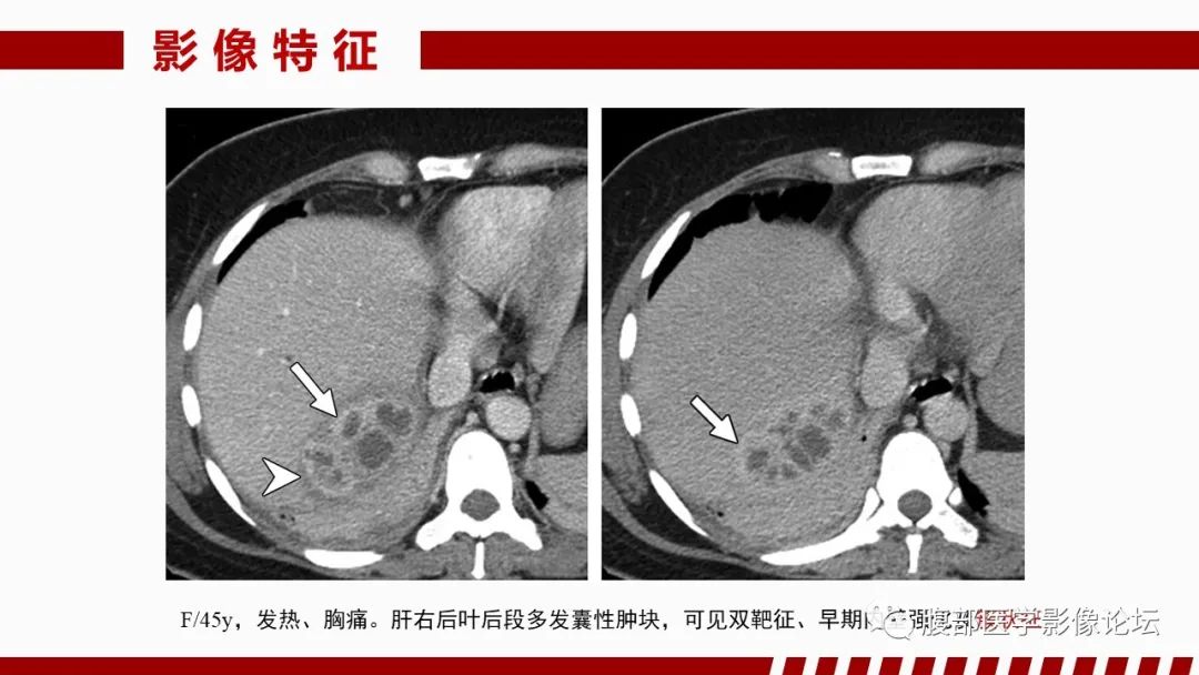 影像PPT - 【PPT】肝脏感染性疾病的多模态影像诊断及鉴别-19