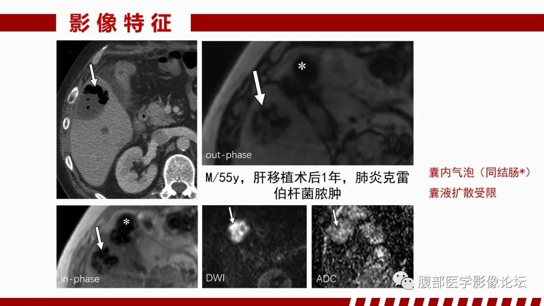 影像PPT - 【PPT】肝脏感染性疾病的多模态影像诊断及鉴别-21