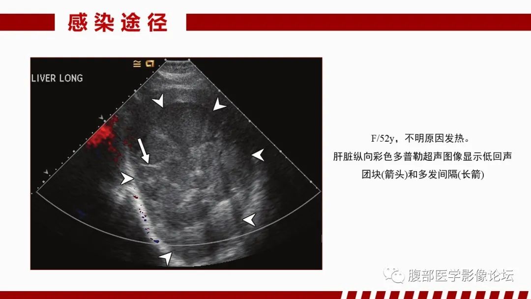 影像PPT - 【PPT】肝脏感染性疾病的多模态影像诊断及鉴别-13
