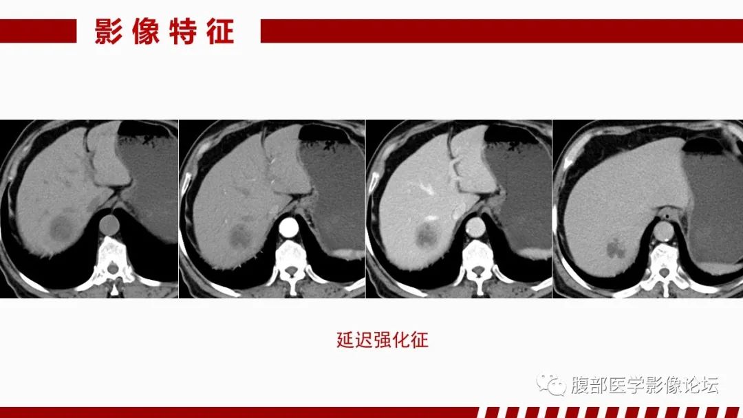 影像PPT - 【PPT】肝脏感染性疾病的多模态影像诊断及鉴别-18