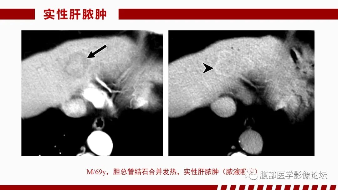 影像PPT - 【PPT】肝脏感染性疾病的多模态影像诊断及鉴别-24
