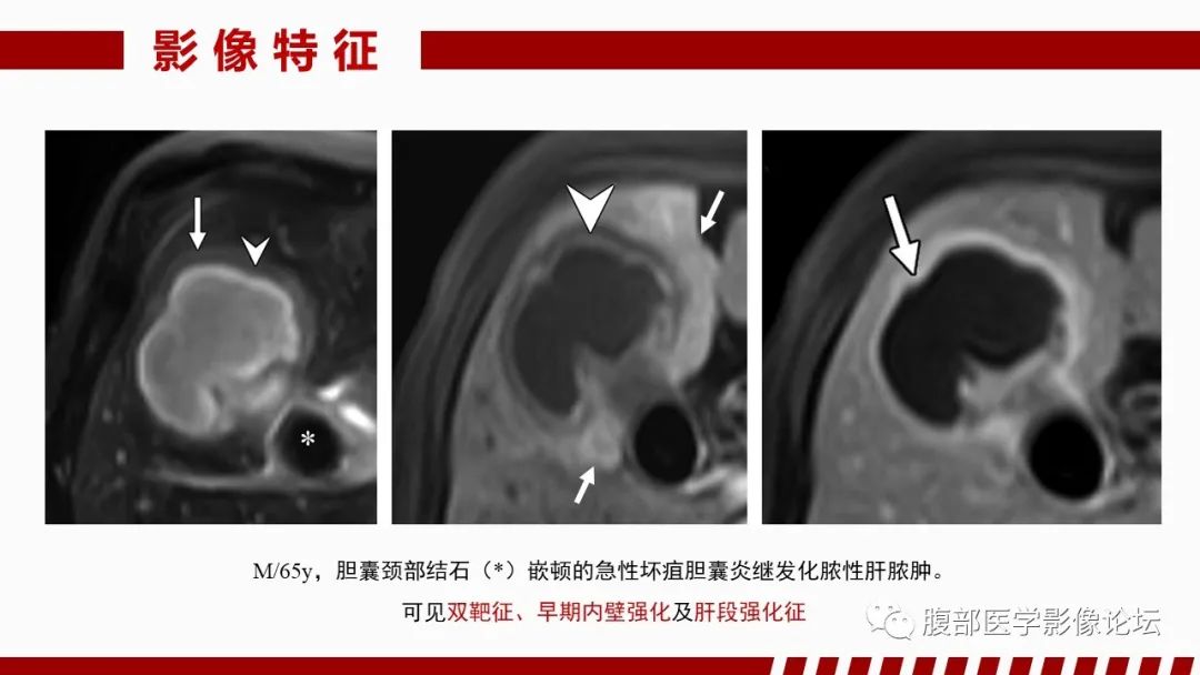 影像PPT - 【PPT】肝脏感染性疾病的多模态影像诊断及鉴别-20