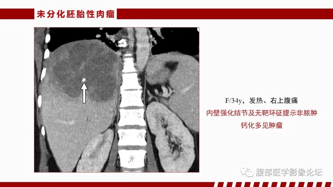 影像PPT - 【PPT】肝脏感染性疾病的多模态影像诊断及鉴别-25
