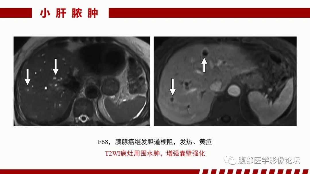 影像PPT - 【PPT】肝脏感染性疾病的多模态影像诊断及鉴别-26