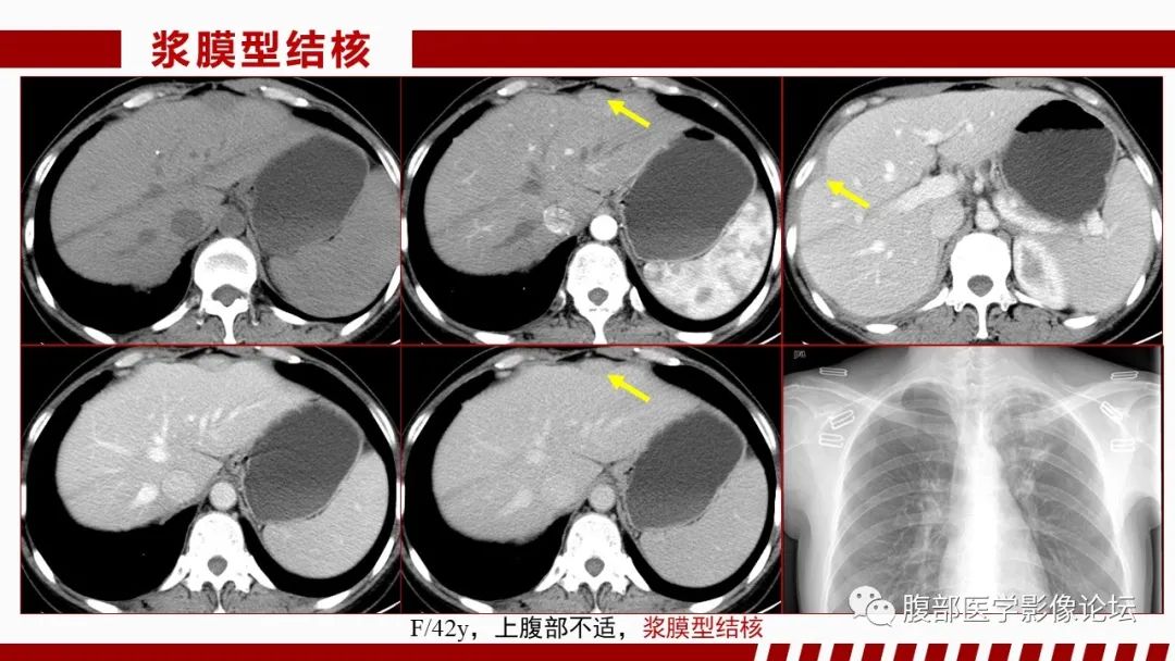 影像PPT - 【PPT】肝脏感染性疾病的多模态影像诊断及鉴别-29