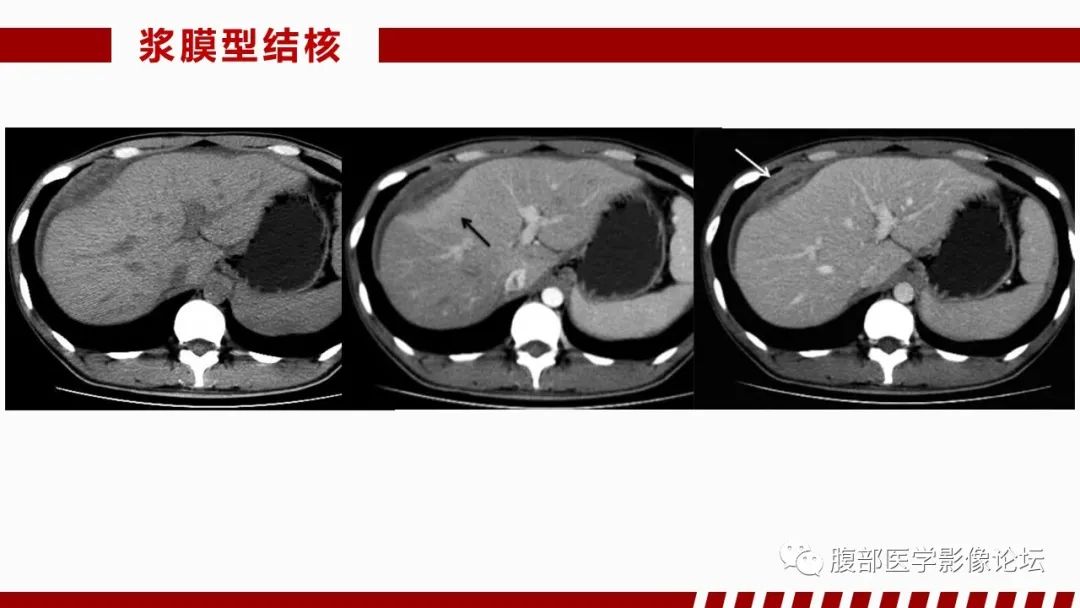 影像PPT - 【PPT】肝脏感染性疾病的多模态影像诊断及鉴别-30