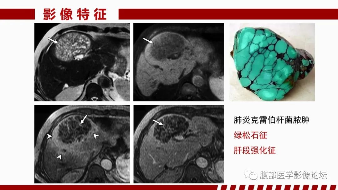 影像PPT - 【PPT】肝脏感染性疾病的多模态影像诊断及鉴别-22