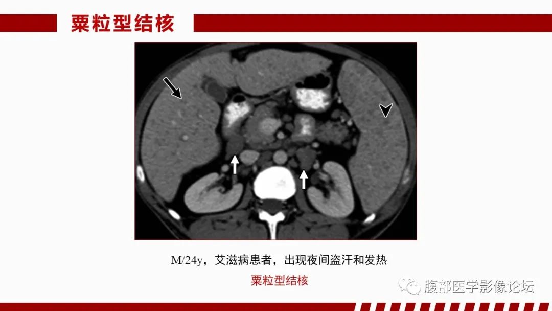 影像PPT - 【PPT】肝脏感染性疾病的多模态影像诊断及鉴别-32