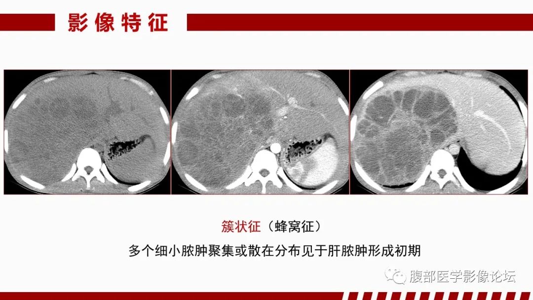 影像PPT - 【PPT】肝脏感染性疾病的多模态影像诊断及鉴别-16